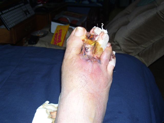 foot injury 008.jpg - 41kB