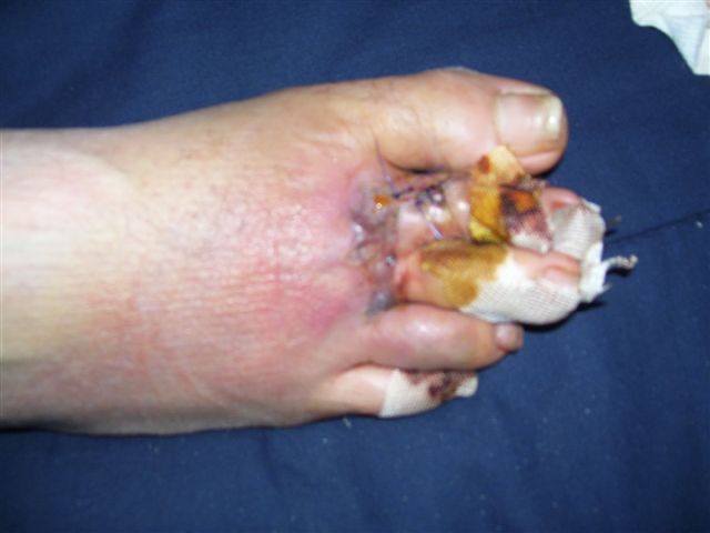 foot injury 021.jpg - 34kB