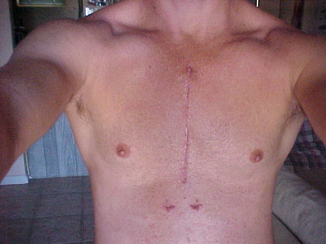 chest 12days.JPG - 51kB